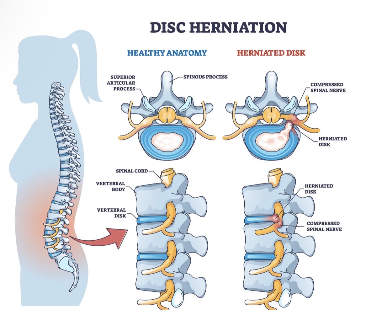 A Look Behind The Back Pain: Understanding Herniated Discs & Other Common Culprits